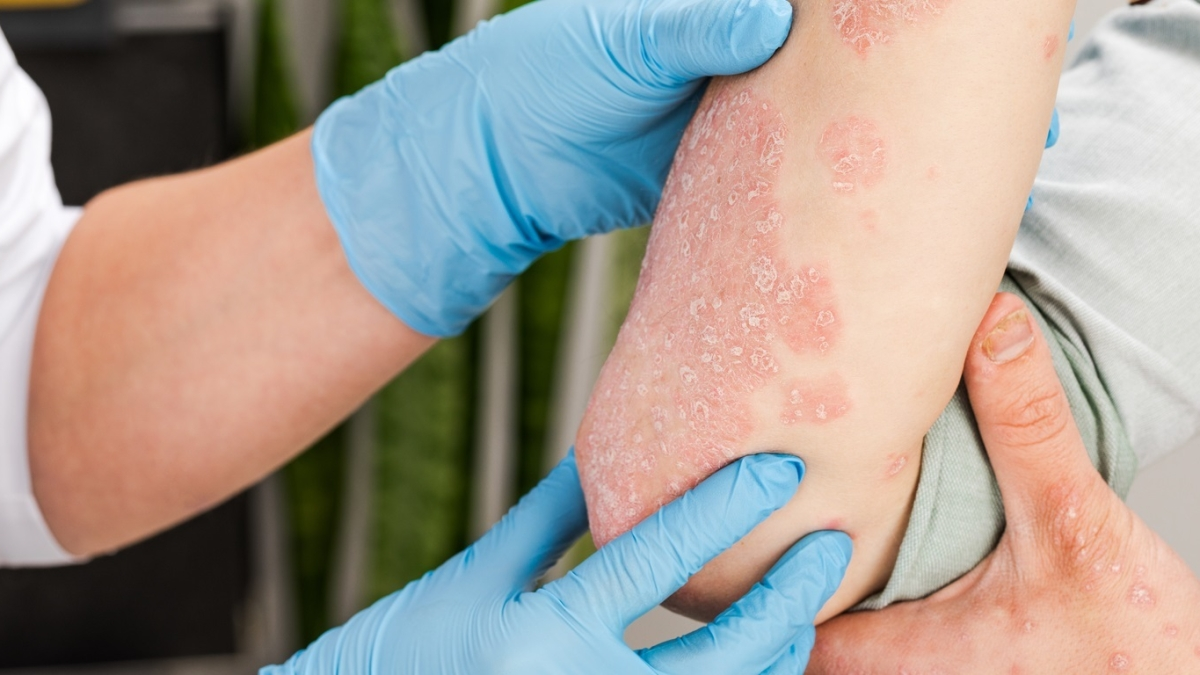 Advances in therapy make it possible to achieve complete remission of psoriasis in 50% of cases.